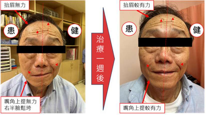 顏面神經麻痺 中醫針灸效果好